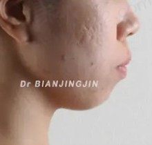 沈阳矫正牙齿卞晶晶医生咋样？亲历正畸超厉害强拯救了我的大龅牙