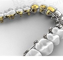 上海天佑医院口腔科牙齿矫正多少钱？舌侧矫正仅需58000元起