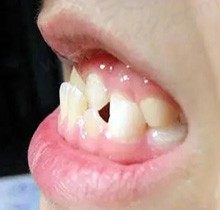 儿童反颌矫正价目表请参考，并说说儿童反颌矫正器哪种比较好