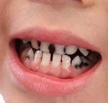 小孩恒牙坏了的处理办法是什么？是拔还是补呢本篇揭晓！