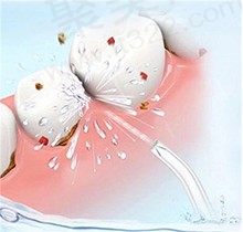 牙周洁治和洗牙有什么区别？为啥洗完牙半年了满嘴还是不舒服