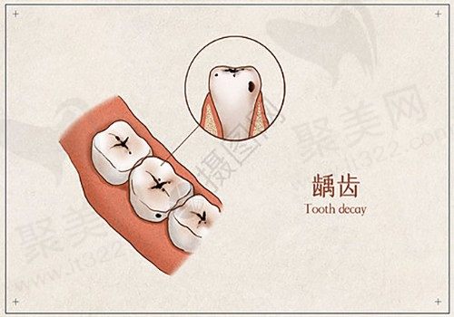 儿童龋齿到底需不需要治疗呢，龋齿治疗方法有哪些？