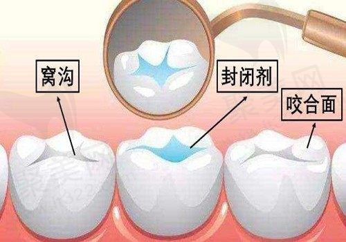 儿童多大年龄适合做窝沟封闭，对牙齿有损伤吗？