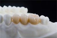 全瓷牙几号颜色更自然？烤瓷牙和全瓷牙有啥区别？到底哪个好