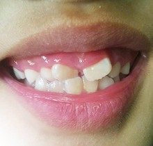 儿童刚长的门牙畸形怎么办？速览儿童门牙龅牙|长歪|门牙缝大治疗方法