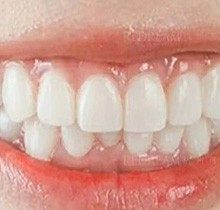 做了牙贴面感觉像龅牙怎么办？可以把牙贴面打磨薄重新做吗？
