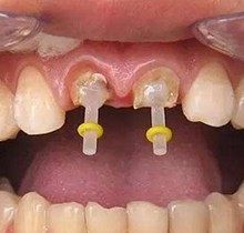 后悔把烂牙根拔了？过来人告诉你烂牙根拔好还是不拔好！