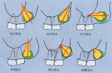 有没有哪种智齿非常难拔图片啊，好奇智齿必须上下拔一对吗