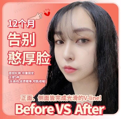 韩国TS面部轮廓双重固定, 天使5种(长曲线,皮质截骨,咬肌收缩)手术记录！
