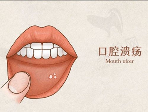 口腔溃疡怎么办非常快非常有效的方法有什么？以及如何预防口腔溃疡？