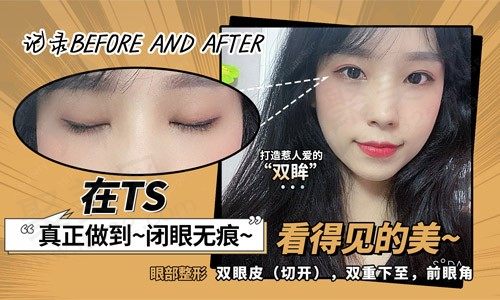 韩国TS整形外科医院切开双眼皮手术真人案例，细节把控塑造灵动大眼！
