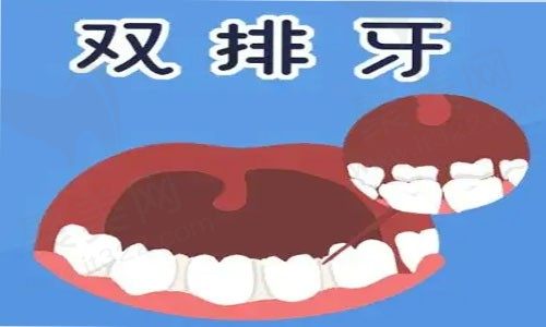 双排牙会自动归位吗？小孩长出双排牙怎么办？