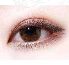 双眼皮埋线好还是割好？双眼皮有几种款式多久能恢复自然？