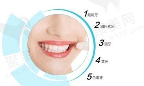 牙齿贴面需要磨牙吗？做牙齿贴面需要多少钱一颗？