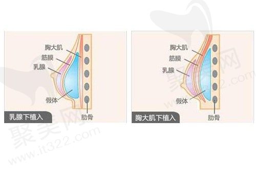 上海首尔丽格殷初阳胸部整形技术怎么样，优势都有哪些?