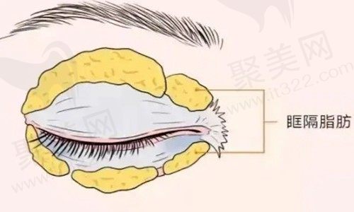 东莞割双眼皮的医院哪家好？东莞罗恩医疗美容全切双眼皮自然放大双眸