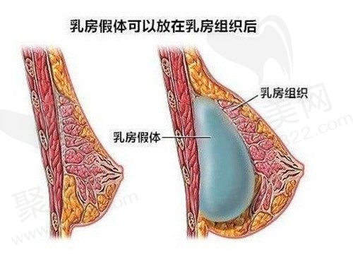 做完丰胸手术后可以哺乳吗？想知道丰胸假体能放一辈子吗？
