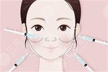 苹果肌填充可以维持多久？想知道有什么人不适合填充苹果肌？