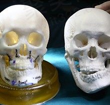 从沈阳杏林朱石江正颌手术病例，深度了解朱石江正颌做的怎么样
