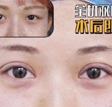 沈阳杏林做双眼皮哪个医生好？张莹莹 房红超 杜继凤双眼皮修复好恢复快