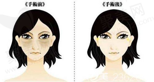 北京田永成医生祛眼袋怎么样？找到了案例介绍+口碑真挺靠谱