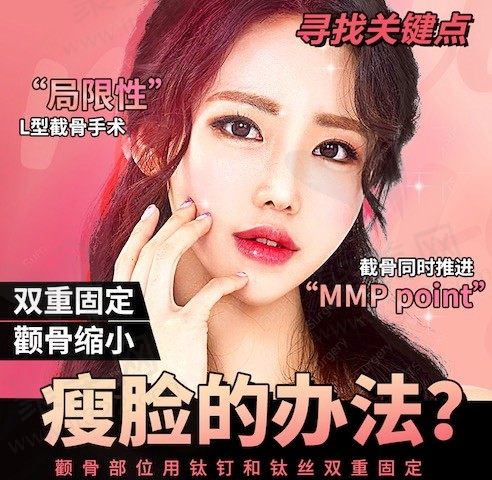 面部轮廓颧骨缩小成功的关键点，双重固定颧骨缩小术！