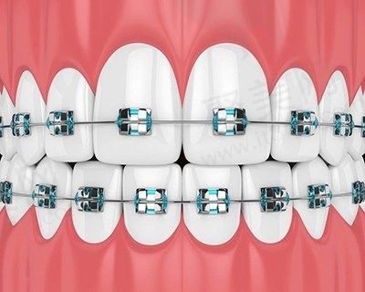 听说张家口麦格口腔矫正不贵？金属托槽矫正6K起真的划算啊