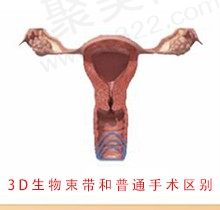 3D生物束带和普通手术区别！3d生物束带紧缩到几指会吸收吗