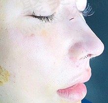 李鸿君做鼻子怎么样？量身打造妈生鼻、肋骨鼻、鼻修复口碑极好