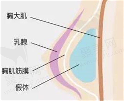做了隆胸假体怎样判断移位了？想问隆胸假体躺下时滑动正常吗