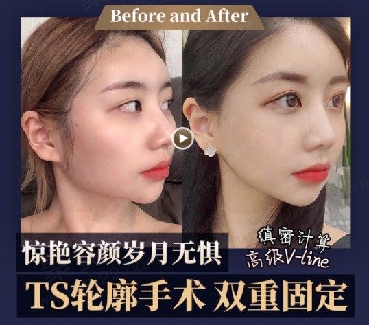 韩国TS整形外科医院颧骨+下颌角手术真人案例，术后一年恢复记录！