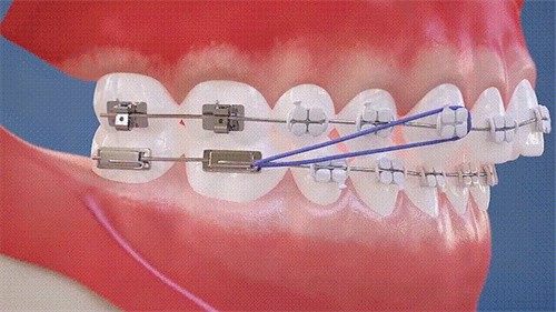 商丘中韩口腔牙齿矫正怎么样？金属托槽矫正性价比高技术奈斯