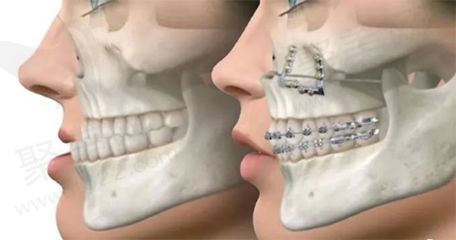 正颌手术矫正后对比