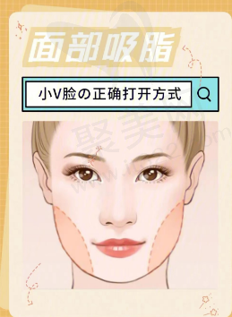 面部吸脂