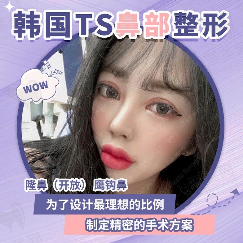 韩国TS整形医院做鼻子怎么样？看鹰钩鼻整形术后一年恢复记录！