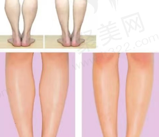 小腿吸脂