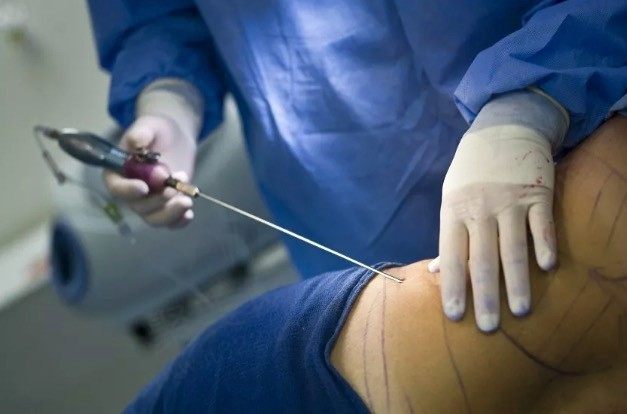 一般腰腹环吸抽脂多少钱？腰腹环吸抽脂有什么副作用和危害吗？