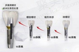 韩国奥齿泰Osstem种植体
