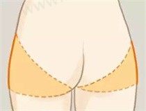 自体脂肪丰臀