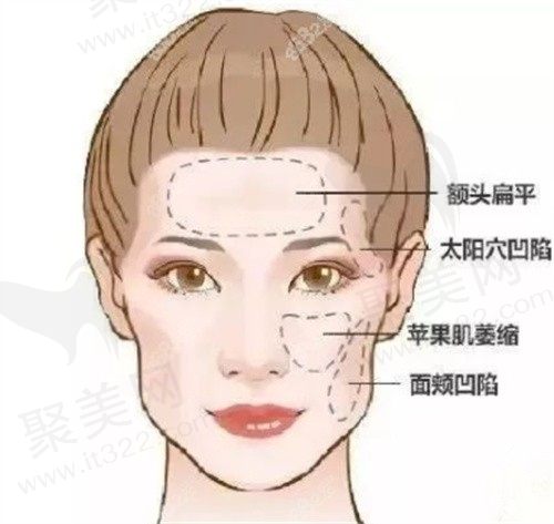 面部填充可以改变脸型吗？目前面部填充较好的方法是这几种呢