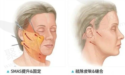 黄广香医生怎么预约？打电话/线上预约咨询黄广香拉皮丰胸问题
