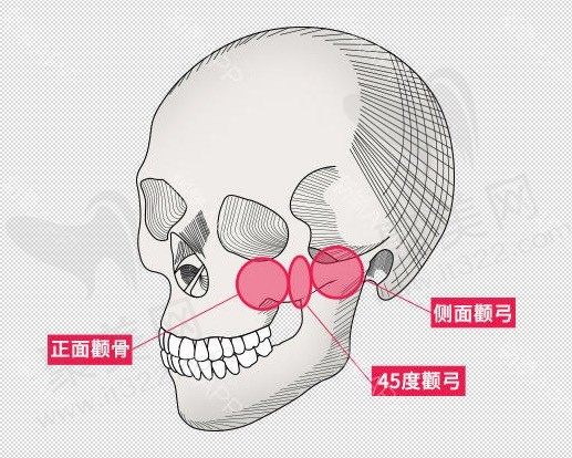 颧骨内推加下颌角一共多少钱？做颧骨内推和下颌角一共花5万算贵吗？