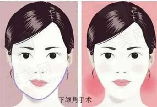 穆雄铮磨骨技术怎么样？下颌角磨骨风格自然亲自做手术价格还低
