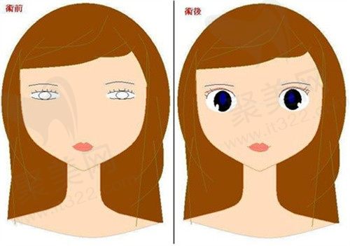 割双眼皮2年后眼皮紧绷正常吗？想知道双眼皮失败鉴定标准