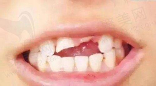 小孩门牙磕掉一小块怎么修复？补前门牙缺口大概多少钱？