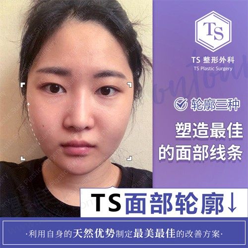 韩国TS整形外科轮廓手术，利用天然优势塑造顺滑之脸型！