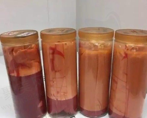 通过抽脂后悔的真实经历，看吸脂对身体的危害和副作用有哪些？