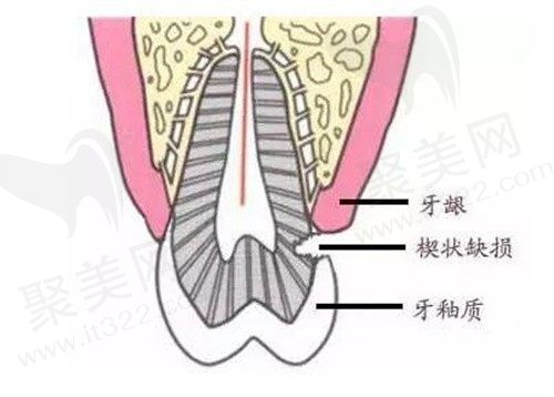 牙齿有小洞千万别补可信嘛？想知道哪种的补牙材料比较耐用？
