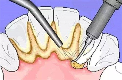 帮问：得了牙周炎每年都要刮治吗？全口牙周刮治多少钱一次？