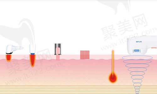 7d聚拉提全脸多少钱做一次？7d聚拉提和超声炮的区别在哪里